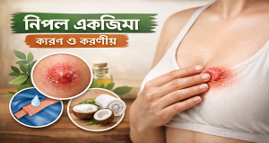 নিপল একজিমা কি? নিপল একজিমা হলে করণীয়