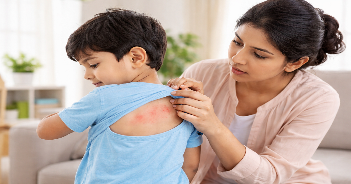 ছোট বাচ্চাদের চুলকানি.png